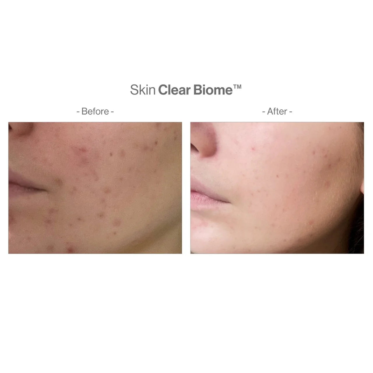 【醫學級內調抗瘡】套裝 Skin Clear Biome™ & Skin Accumax™