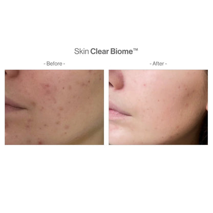 【醫學級內調抗瘡】套裝 Skin Clear Biome™ & Skin Accumax™