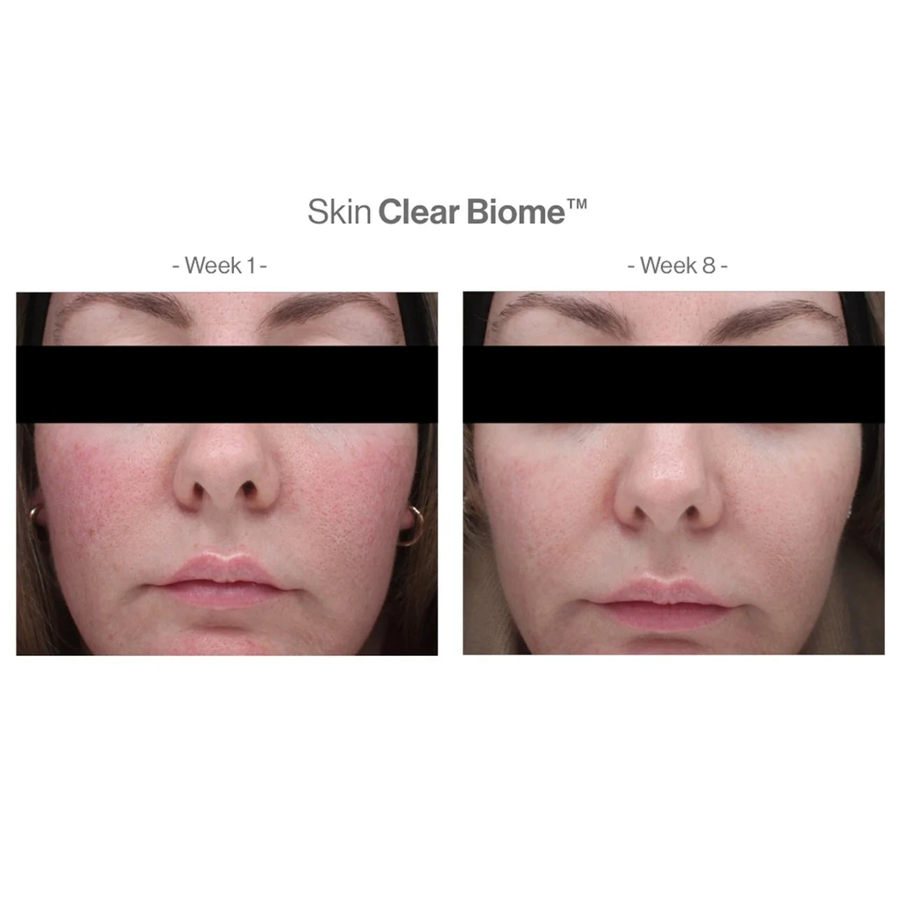 【醫學級內調抗瘡】套裝 Skin Clear Biome™ & Skin Accumax™