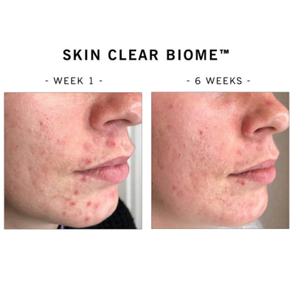 【醫學級內調抗瘡】套裝 Skin Clear Biome™ & Skin Accumax™
